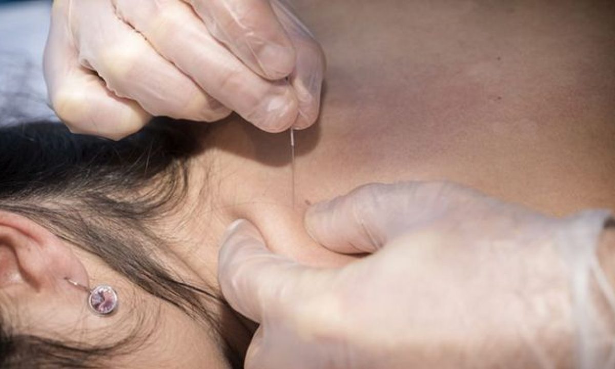 Para qué sirven las agujas de acupuntura? Conoce sus beneficios