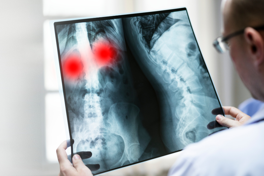 escoliosis radiografia